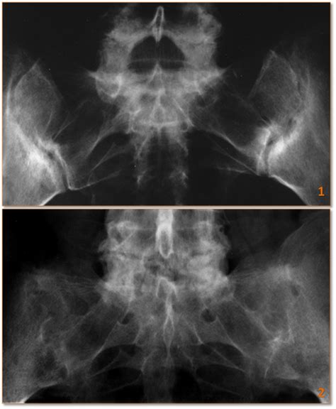 Ankylosing Spondylitis Radrounds Radiology Network
