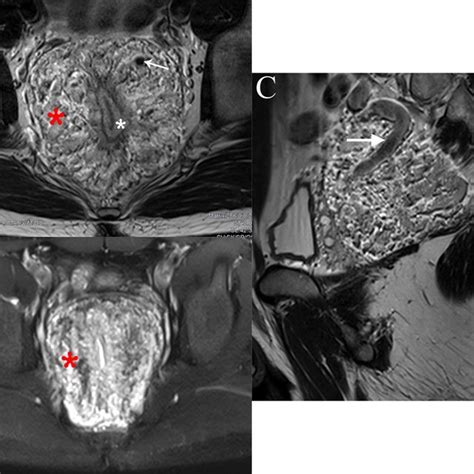 Rectal Mri A Axial T2 Weighted Images Showing Wall Thickening Of The