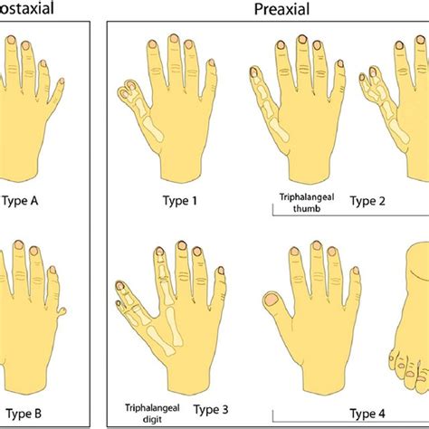 Pdf Genetic Overview Of Syndactyly And Polydactyly