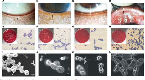 Figure 2 From Pathogens In The Meibomian Gland And Conjunctival Sac Microbiome Of Normal