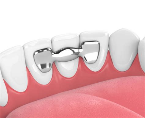 Qué es un puente dental tipos y características Clinica Dental Oris