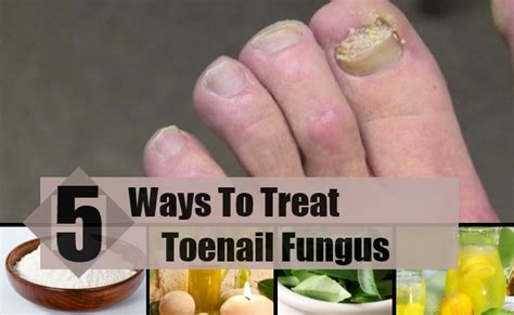5 Best And Effective Ways For Toenail Fungus Treatments Find Home