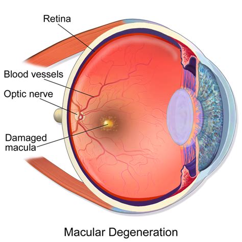 Amazon's choice for macular degeneration lamps. Treatment for Macular Degeneration (AMD) | eSight