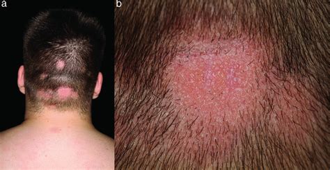 Cicatricial Alopecia Kanti 2018 Jddg Journal Der Deutschen