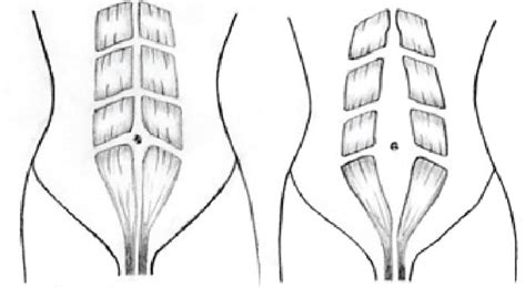 Postpartum Diastasis Recti Causes Symptoms And Home Treatment Hubpages