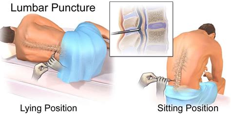 Lumbar Puncture Spinal Tap Procedure And Side Effects
