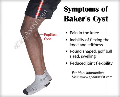 What Are The Signs And Symptoms Of Bakers Cyst Or Popliteal Cyst