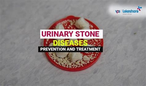 Urinary Stone Disease Prevention And Treatment Vps Lakeshore