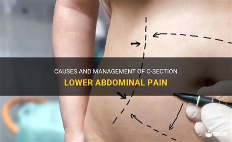 Causes And Management Of C Section Lower Abdominal Pain MedShun