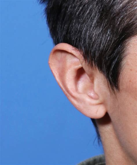 Macrotia Ear Reduction Front View Changes World Expert In Making Ears