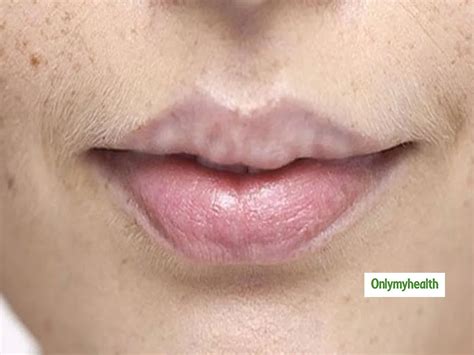 Moglie Mancante Profezia Blue Spots On Lips Pugnalata Deformazione