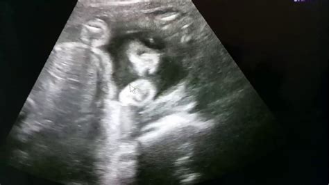 Gambaran usg janin perempuan usia kehamilan 29 minggu 3 hari youtube. 46+ Gambar Usg 2 Dimensi Janin 8 Bulan, Baru!