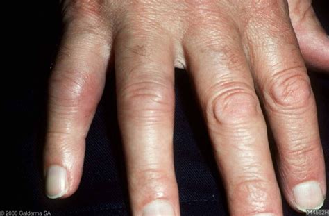 Artritis Psoriatica Huidarts