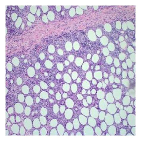 Subcutaneous Panniculitis Like T Cell Lymphoma Wikidoc