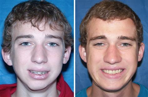 Before And After Case 20 Tmj Surgery Ankylosis Larry M Wolford Dmd