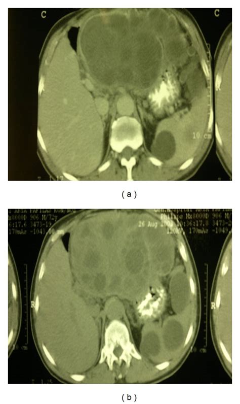 Ct Showed A Large Echinococcal Cyst With Daughter Cysts In The Left