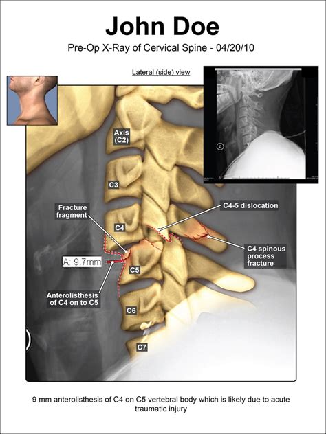 Pre Op Cervical Spine X Ray Illustration By Visuals For Law Medical
