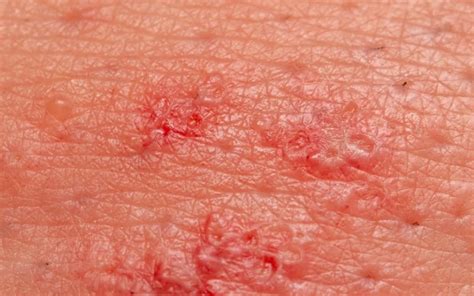 Skin Ulcers Causes Diagnosis And Effective Treatments