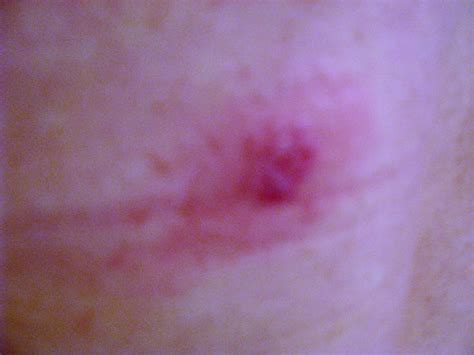 Many people who are bitten by black widow spiders never seek medical care. Pin on Breads & Rolls
