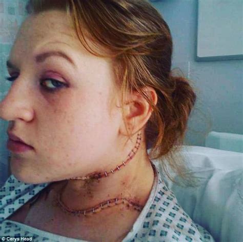 Overweight Exeter Woman Discovers She Has Thyroid Cancer Daily Mail