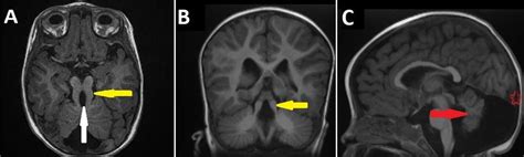 Mri Of Joubert Syndrome Associated With Dandy Walker Malformation
