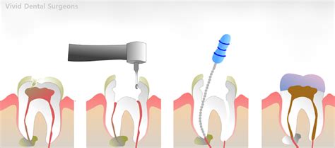 Root Canal Treatment In Tiong Bahru Vivid Dental Surgeons