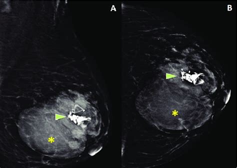 Mammogram Of The Left Breast A Mediolateral Oblique And B