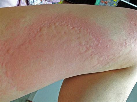 Tegnsætning Realistisk Kobber Liver Disease Red Spots On Skin Scheele