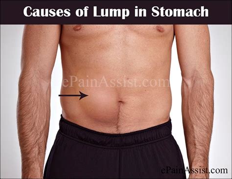 Lump In Stomach Or Abdominal Masscausessymptomstreatmentprognosis