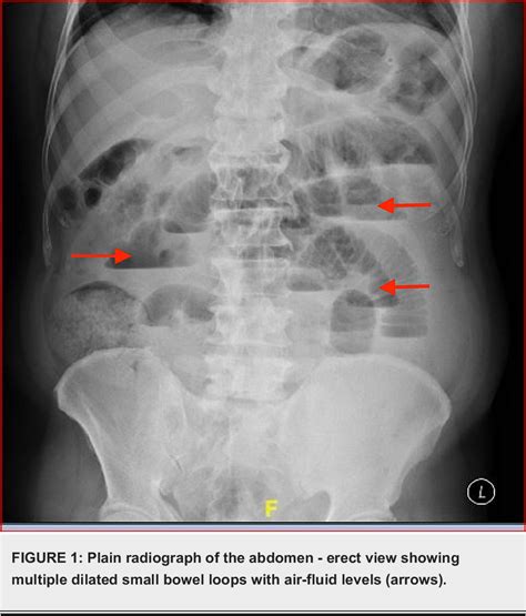 Figure 1 From Acute Pancreatitis As The Index Manifestation Of