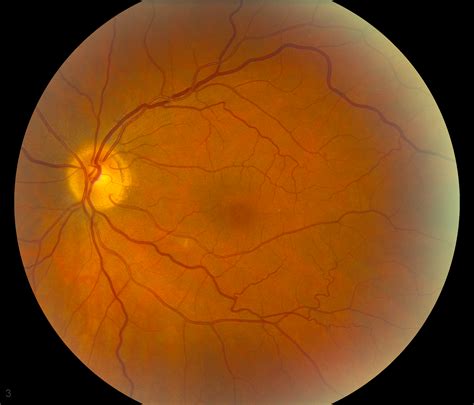 Vitamin A Deficiency and Nyctalopia. EyeRounds.org - Ophthalmology - The University of Iowa
