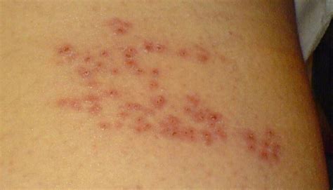 Shingles Symptoms And What You Need To Know Seereadshare