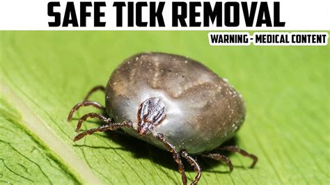 How To Safely Remove Ticks Tick Removal Youtube