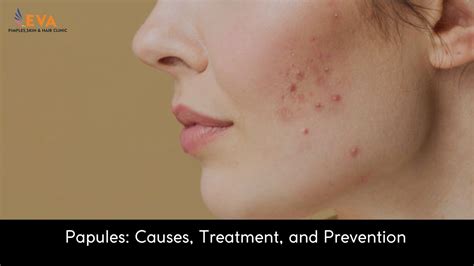 Papules Causes Treatment And Prevention Eva