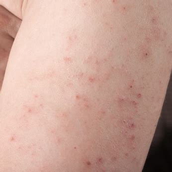 Rashes That Come And Go Possible Causes And Corresponding Treatments New Health Advisor