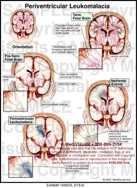 Medivisuals Periventricular Leukomalacia Medical Illustration