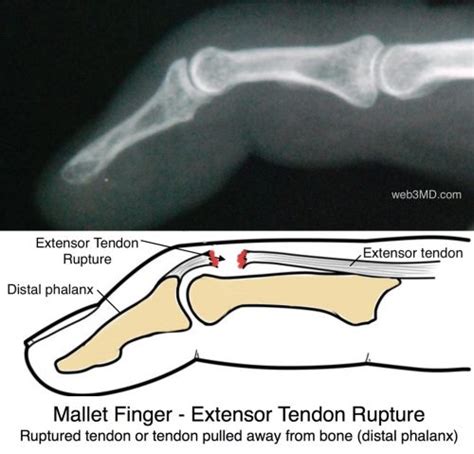 Mallet Finger Tendon Rupture 1024 The Orthopedic And Sports Medicine