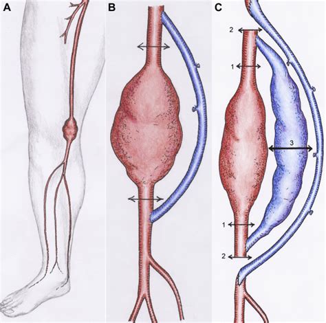 An Aneurysmal Degeneration Of Venous Bypass For Popliteal Artery