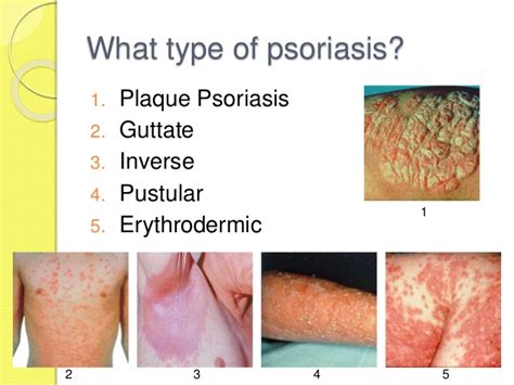 Psoriasis Diet Pictures Treatment Symptoms And Causes