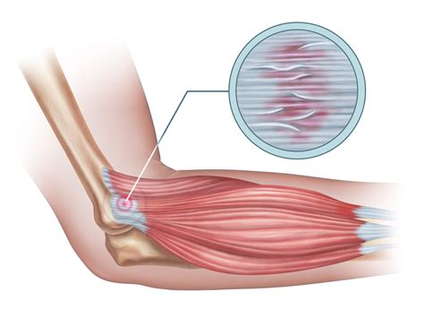 Forearm pain from muscle or tendon injuries can be quite debilitating. Why We're Often Failing Our Lateral Epicondyle Patients ...