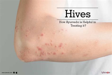 Chronic Hives How Ayurveda Remedies Helpful In Treating It By Dr
