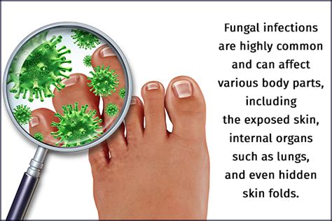 Fungal Infections Symptoms Risk Factors And Treatment