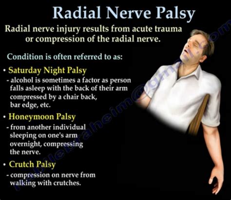 N Radialis Entrapmentneuropathieën Van De Arm Radial Nerve Nerve