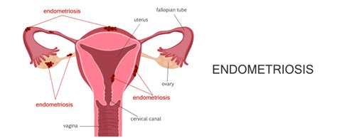 The most common symptom of womb cancer is abnormal bleeding from the vagina, although most people with abnormal bleeding do not have cancer. Genetic Causes of Endometrial Cancers