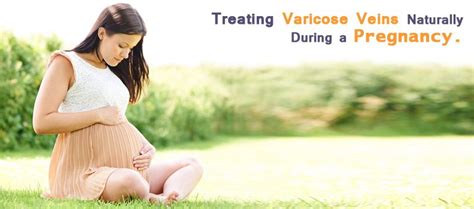 Treating Varicose Veins Naturally During A Pregnancy Karishma