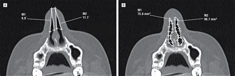 Reformatted Computed Tomography To Assess The Internal Nasal Valve And