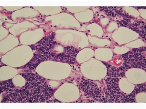 Merkel cell carcinoma occurs when something goes wrong within these cells and causes them to grow uncontrollably. Dermpath Made Simple - Neoplastic: Merkel Cell Carcinoma