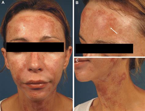Severe Erythema And Hyperpigmentation Following Chemical Peel A The