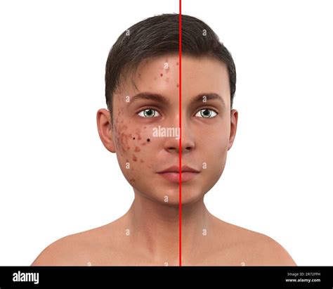 Acne Vulgaris On A Teenage Boys Face Computer Illustration Showing