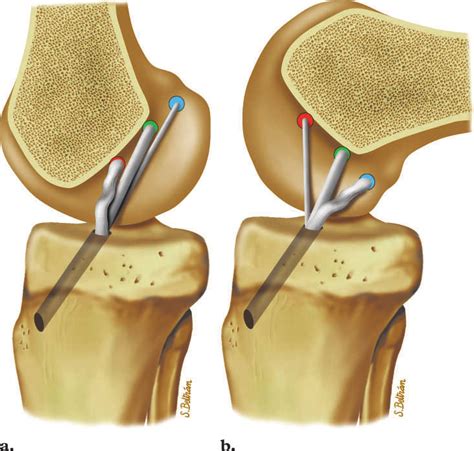 Effects Of Femoral Tunnel Placement On Graft Length And Tension